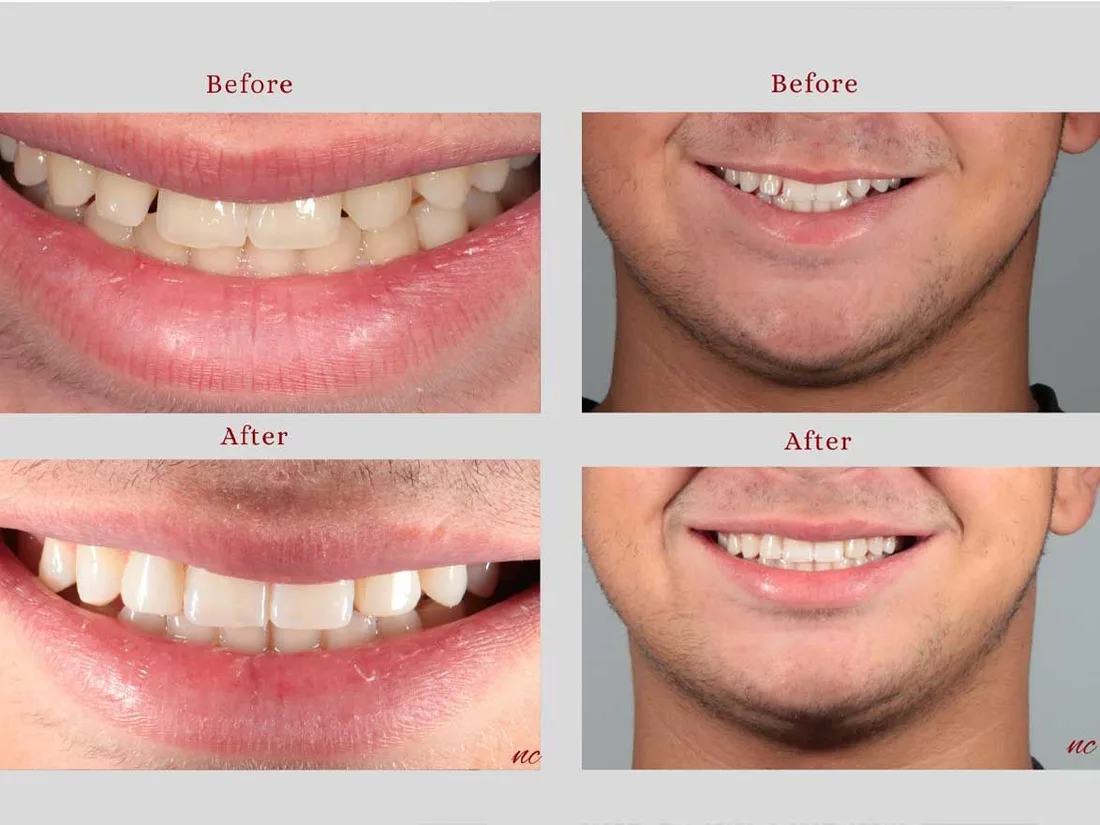 Cosmetic dentistry result at Chaptini Smile Clinic