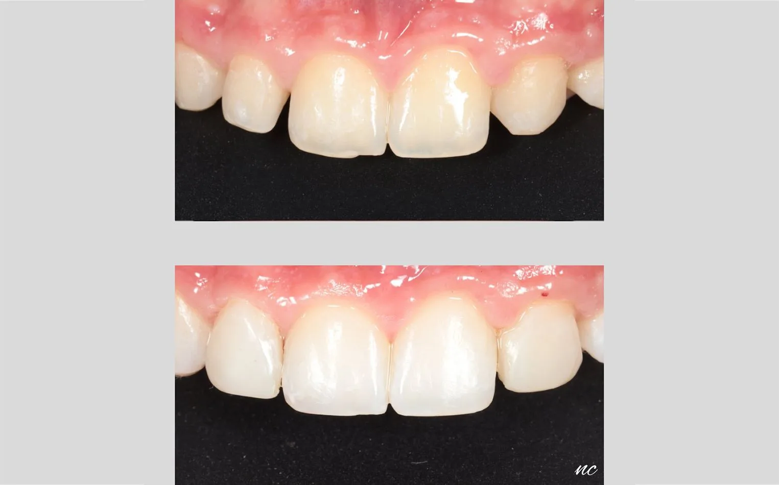 Before and after restorative dentistry closing gaps in the front teeth