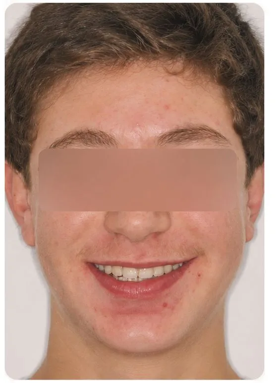 Orthodontic alignment, after treatment