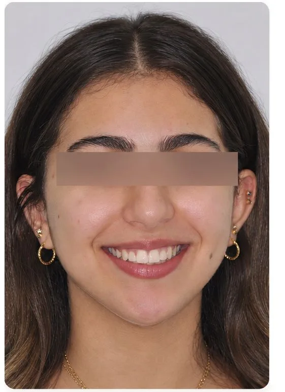 Orthodontic alignment, after treatment