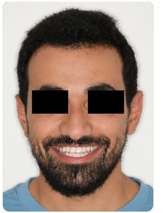 Smile restoration, after treatment