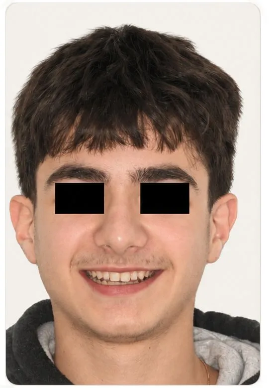 Smile restoration, after treatment