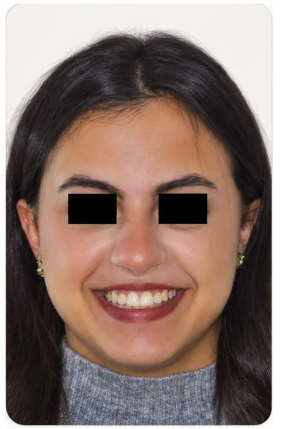 Orthodontic alignment, after treatment