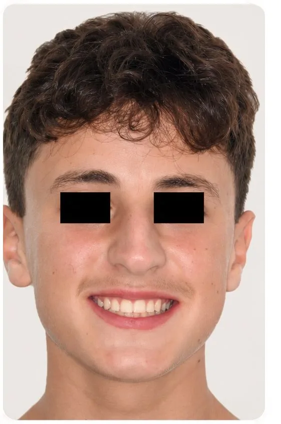 Orthodontic alignment, after treatment