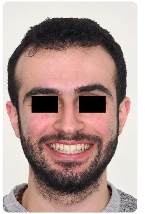 Smile restoration, after treatment