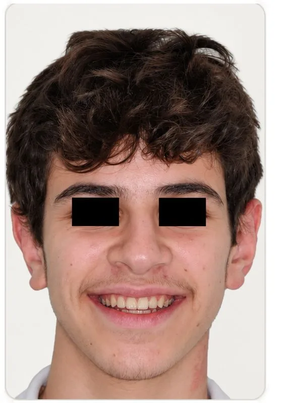 Orthodontic alignment, after treatment