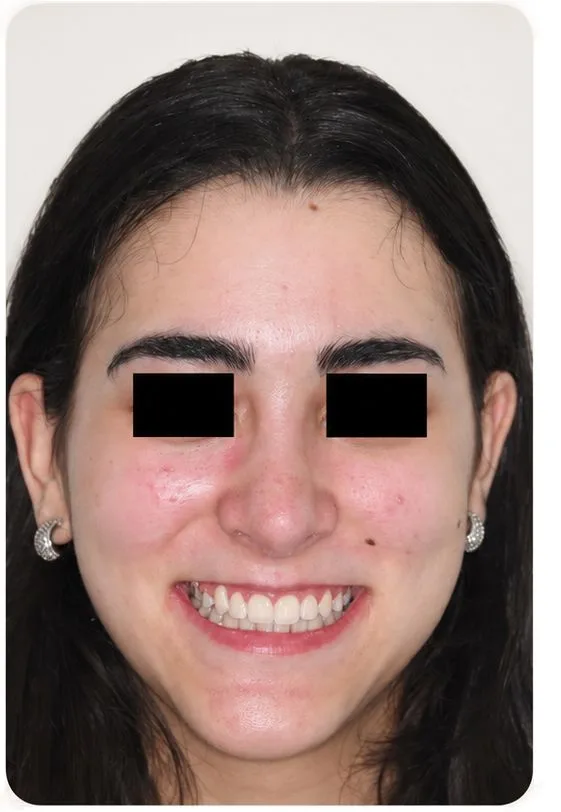 Smile restoration, after treatment