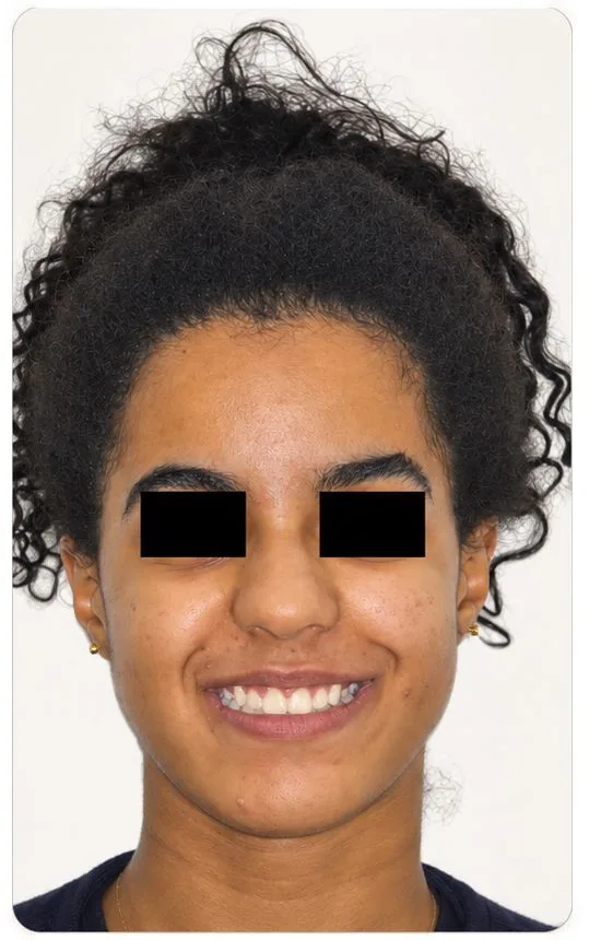 Orthodontic alignment, after treatment