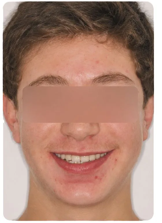 Smile restoration, after treatment